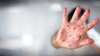 Noi cazuri de rujeolă confirmate printre persoanele cazate la Centrul de plasament temporar din capitală
