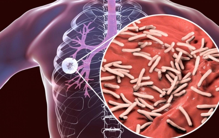 OMS: Tuberculoza continuă să fie una dintre cele mai letale boli infecțioase din lume
