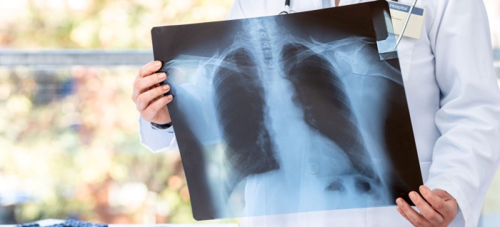 OMS: Tuberculoza a redevenit cea mai mortală boală infecțioasă din lume