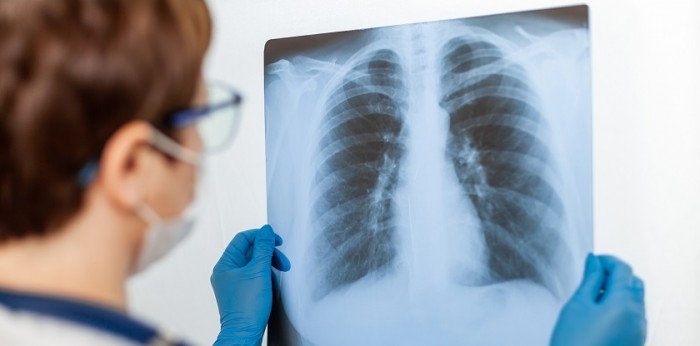 Anul trecut, în Moldova au fost înregistrate 1.734 de cazuri de tuberculoză